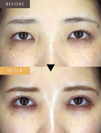 眼瞼下垂＋目頭切開