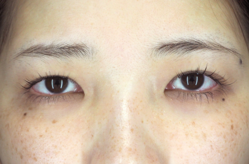 目頭切開法（20代｜女性）