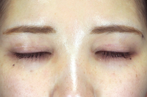 目頭切開法（20代｜女性）3ヶ月後