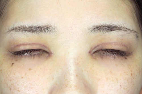 1週間後（抜糸後）