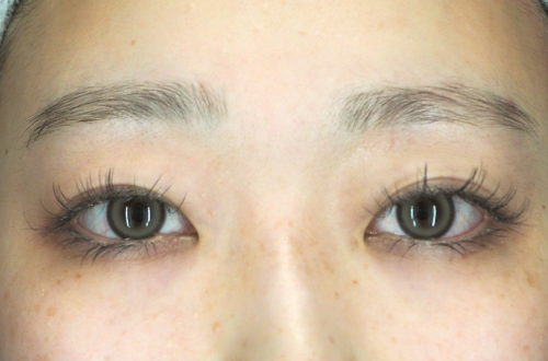 眼瞼下垂(20代|女性)