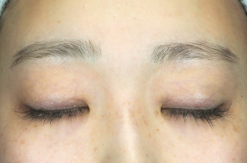 眼瞼下垂(20代|女性)