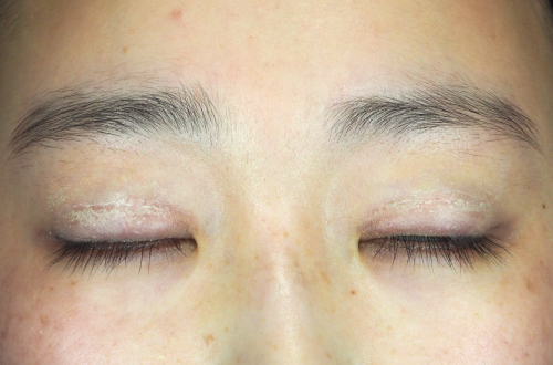 眼瞼下垂(20代|女性)3ヶ月後