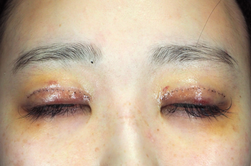 1週間後（抜糸前）