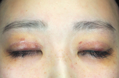 1週間後（抜糸後）