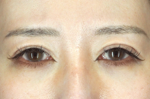 眼瞼下垂(30代|女性)3ヶ月後