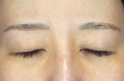 眼瞼下垂(30代|女性)