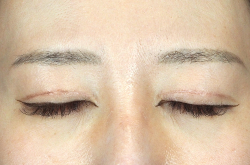 眼瞼下垂(30代|女性)3ヶ月後