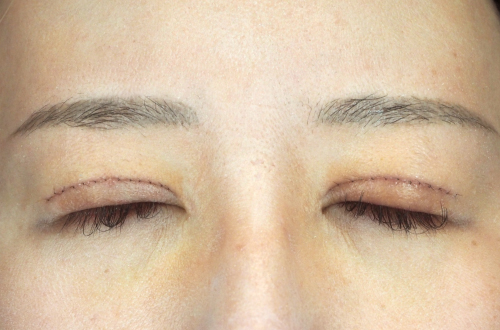 1週間後（抜糸前）