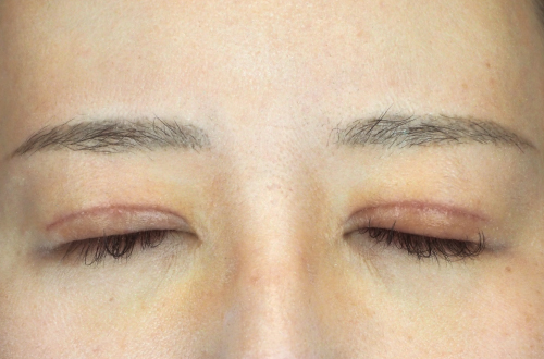 1週間後（抜糸後）