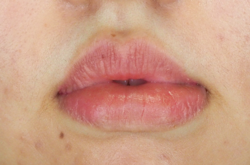 口唇縮小術(20代|女性)