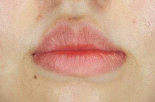 口唇縮小術(20代|女性)3ヶ月後