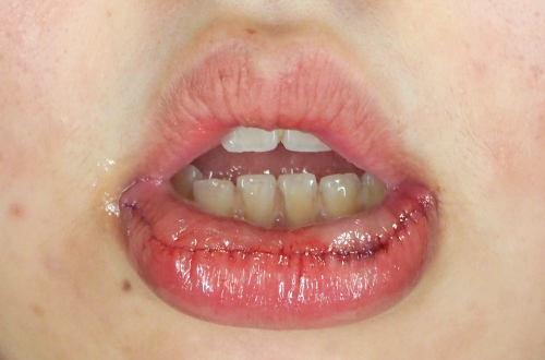 口唇縮小術の施術直後