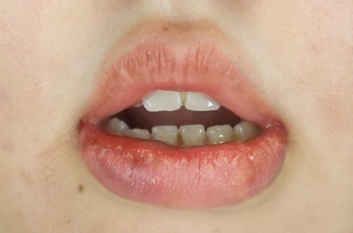 1週間後（抜糸前）