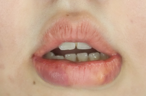 1週間後（抜糸後）