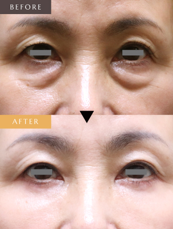 目の下のたるみ取り