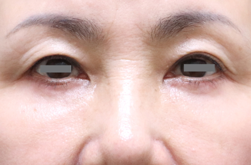 目の下のたるみ取り(50代以上|女性)3ヶ月後