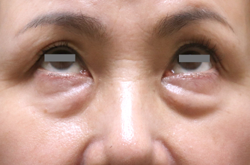 目の下のたるみ取り(50代以上|女性)