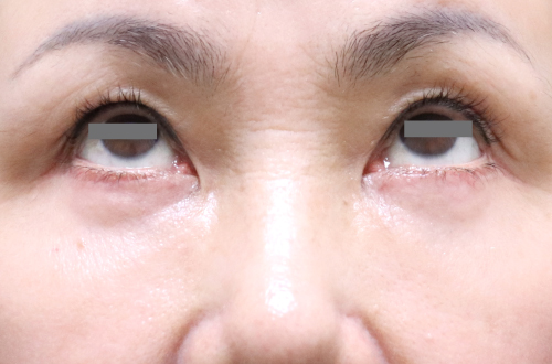 目の下のたるみ取り(50代以上|女性)3ヶ月後