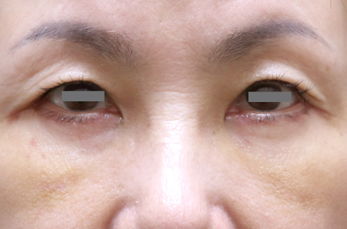 1週間後（抜糸後）