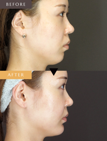 鼻翼基部プロテーゼ