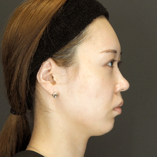 鼻翼基部プロテーゼ（20代｜女性）