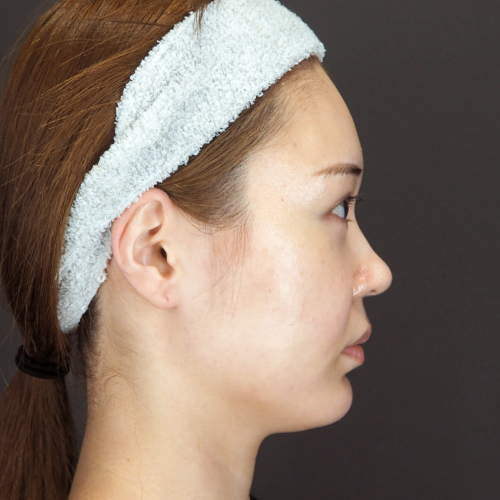 鼻翼基部プロテーゼ（20代｜女性）6ヶ月後