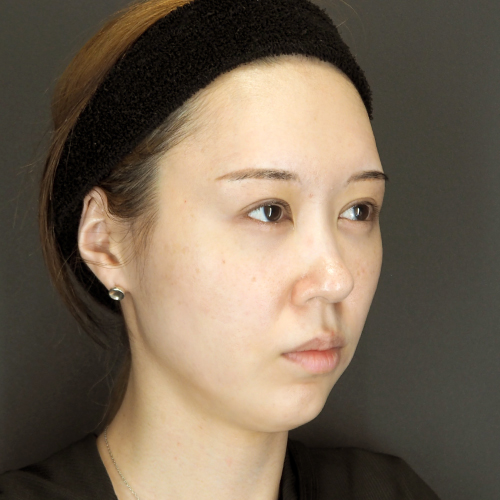 鼻翼基部プロテーゼ（20代｜女性）