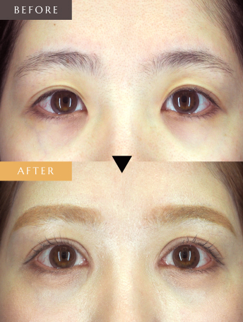 二重切開+目頭切開