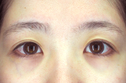 二重切開法(20代|女性)