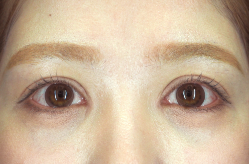 二重切開法(20代|女性)3ヶ月後