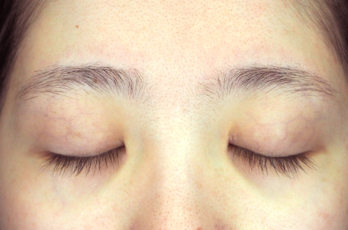 二重切開法(20代|女性)