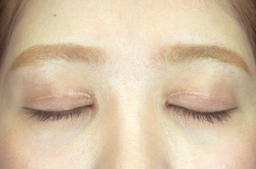 二重切開法(20代|女性)3ヶ月後