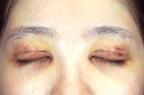 1週間後（抜糸前）