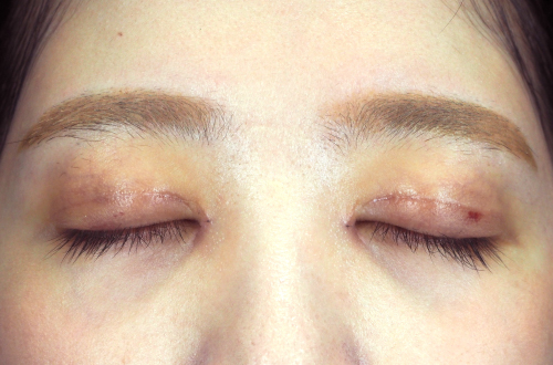 10日後（抜糸後）