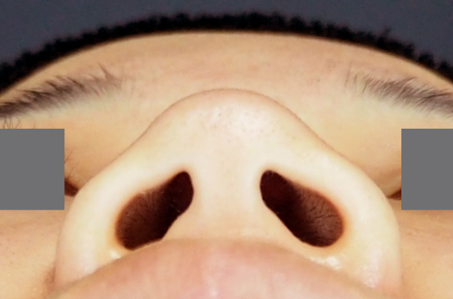 整鼻術（20代｜女性）