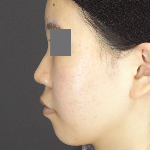 整鼻術（20代｜女性）