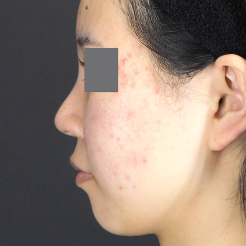 整鼻術（20代｜女性）6ヶ月後