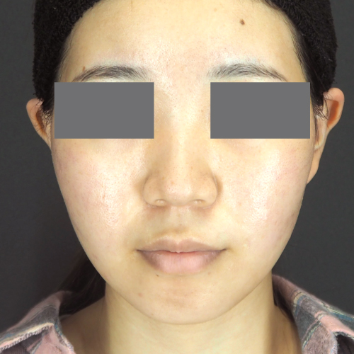 整鼻術（20代｜女性）