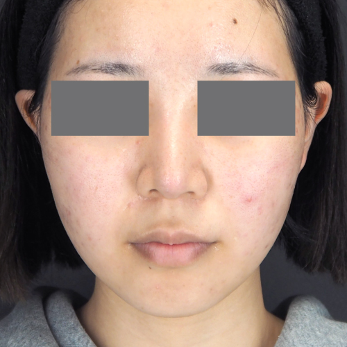 整鼻術（20代｜女性）6ヶ月後