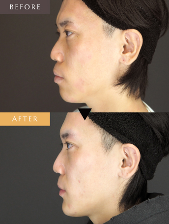 セットバック整形（上下セットバック）