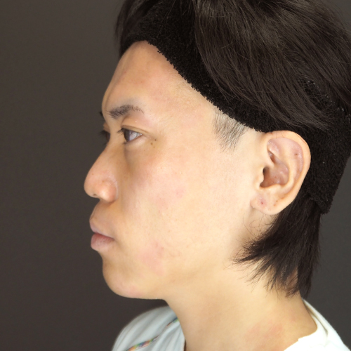 セットバック整形（20代｜男性）