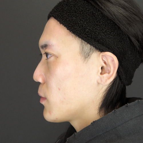 セットバック整形（20代｜男性）6ヶ月後
