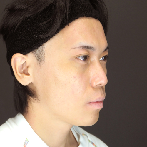 セットバック整形（20代｜男性）