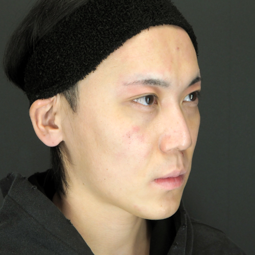 セットバック整形（20代｜男性）6ヶ月後