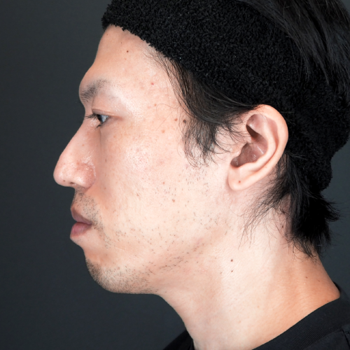 セットバック整形（上下セットバック＋オトガイ広範囲骨切り術）の術前
