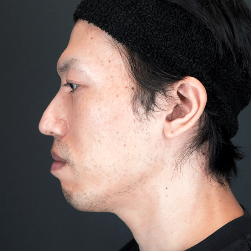 セットバック整形(30代|男性)
