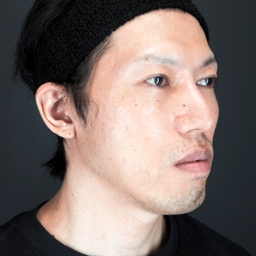 セットバック整形(30代|男性)