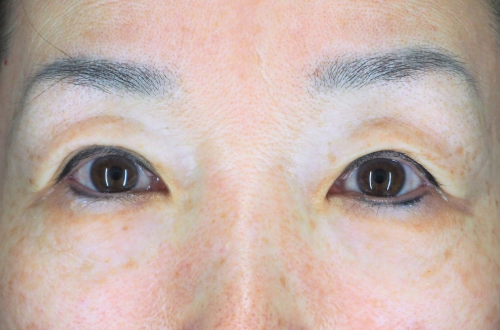 二重切開法(50代以上|女性)