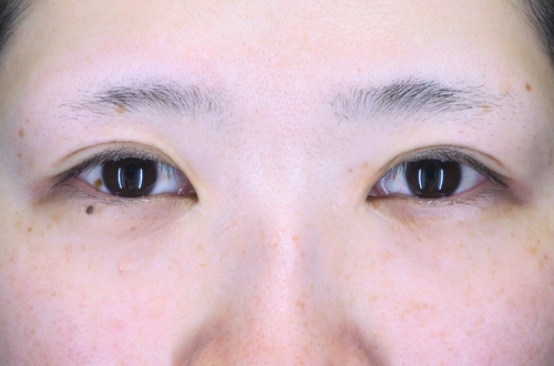 二重切開法(30代|女性)